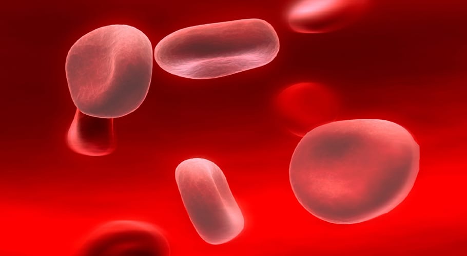 anemia