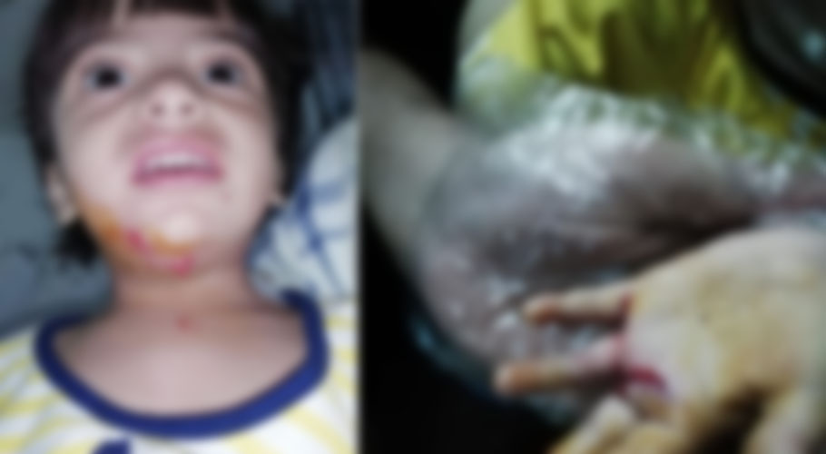 راولپنڈی کی گلیوں میں آوارہ کتوں کا راج، معصوم بچی شدید زخمی