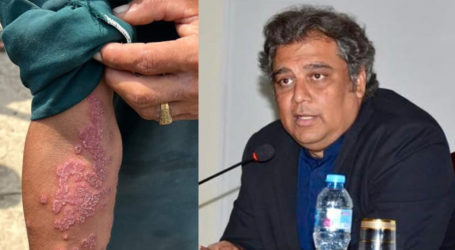 سندھ میں جلد کی بیماری پھیل گئی، علی زیدی کی میڈیکل کیمپ لگانے میں مدد کی پیشکش