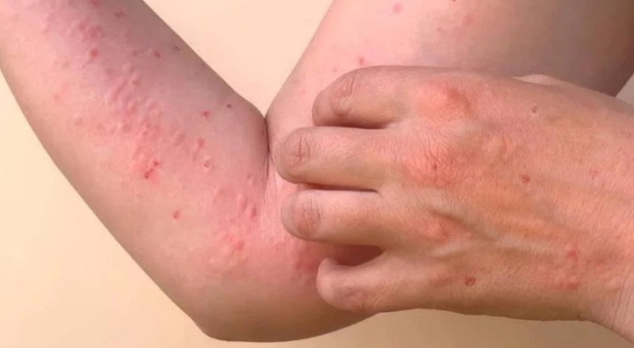 Chikungunya Causes, Symptoms, Diagnosis & Treatment