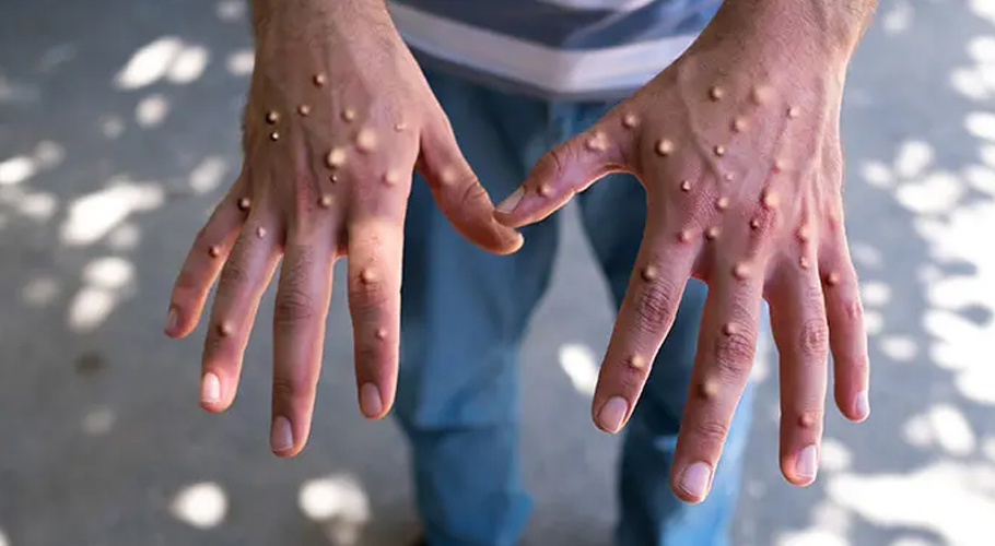 mpox
