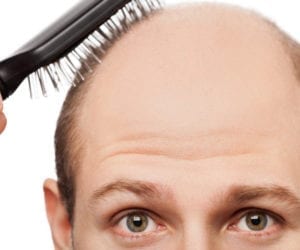 Indian woman registers case after discovering husband’s baldness