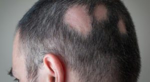 Alopecia causes temporary or permanent patchy hair loss. Source: Medical News.