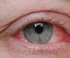 After Karachi, pink eye infection spreads in Lahore