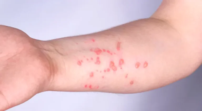 monkeypox